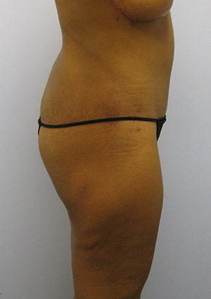 Buttock Lift Before & After Image