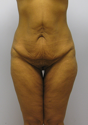 Buttock Lift Before & After Image