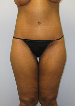 Buttock Lift Before & After Image