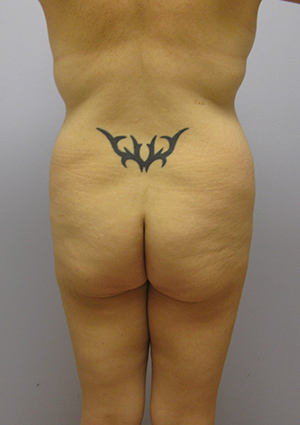 Buttock Lift Before & After Image