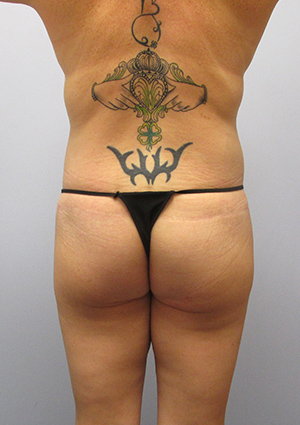 Buttock Lift Before & After Image