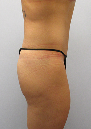 Buttock Lift Before & After Image