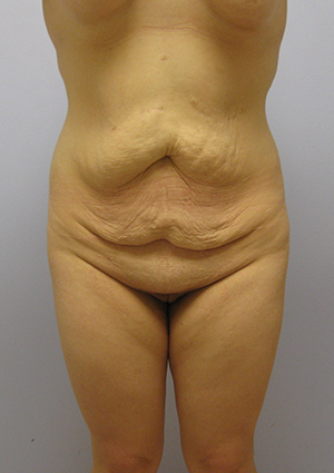 Buttock Lift Before & After Image