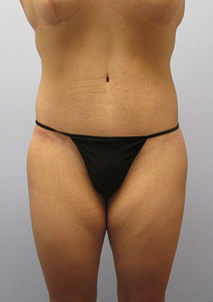 Buttock Lift Before & After Image