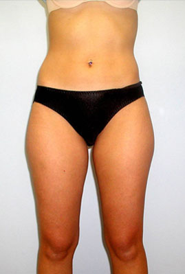 Liposuction Before & After Image