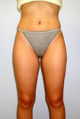 Liposuction Before & After Image