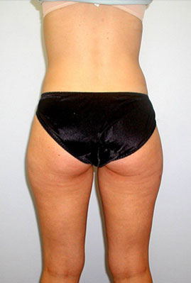 Liposuction Before & After Image