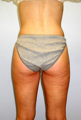 Liposuction Before & After Image