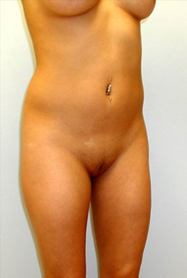 Liposuction Before & After Image