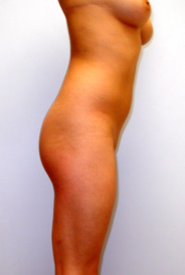 Liposuction Before & After Image