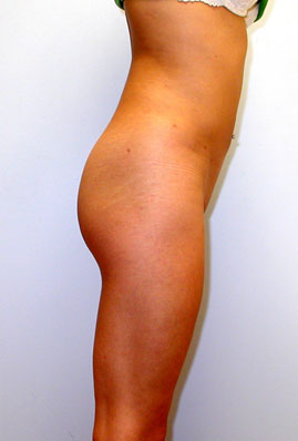 Liposuction Before & After Image