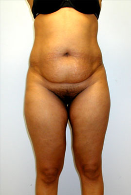 Liposuction Before & After Image