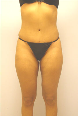 Liposuction Before & After Image