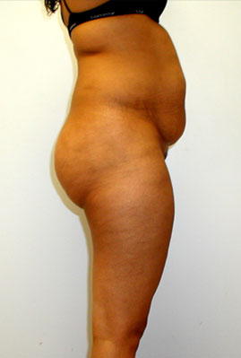 Liposuction Before & After Image