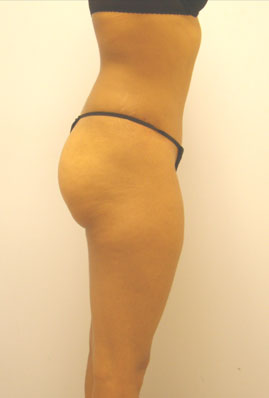 Liposuction Before & After Image