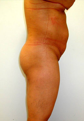 Liposuction Before & After Image