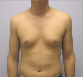 Liposuction Before & After Image