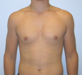 Liposuction Before & After Image