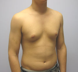 Liposuction Before & After Image