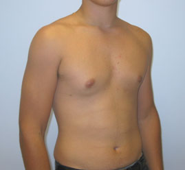 Liposuction Before & After Image