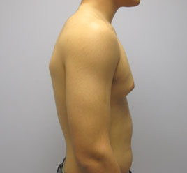 Liposuction Before & After Image