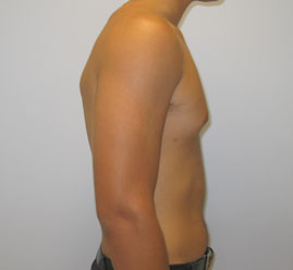 Liposuction Before & After Image