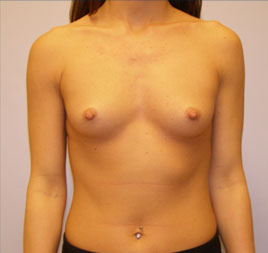 Breast Augmentation Before & After Image