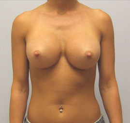 Breast Augmentation Before & After Image