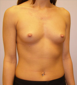 Breast Augmentation Before & After Image