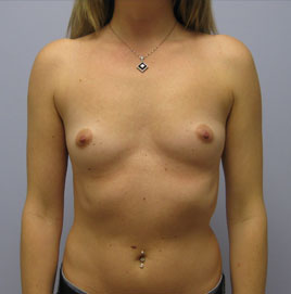 Breast Augmentation Before & After Image