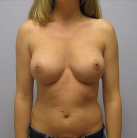 Breast Augmentation Before & After Image