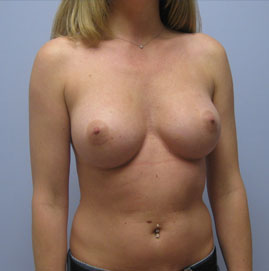 Breast Augmentation Before & After Image