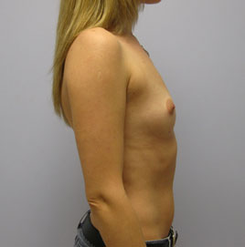 Breast Augmentation Before & After Image