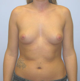 Breast Augmentation Before & After Image