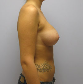 Breast Augmentation Before & After Image