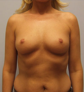 Breast Augmentation Before & After Image