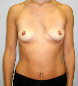 Breast Augmentation Before & After Image