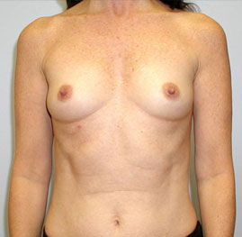 Breast Augmentation Before & After Image