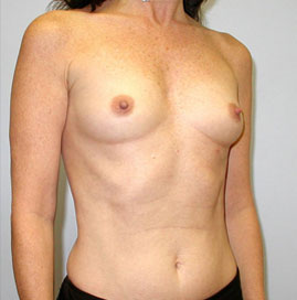 Breast Augmentation Before & After Image