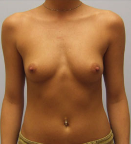 Breast Augmentation Before & After Image