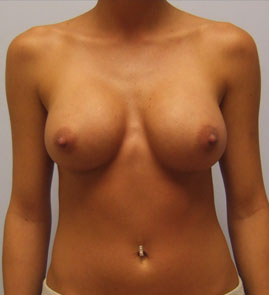 Breast Augmentation Before & After Image