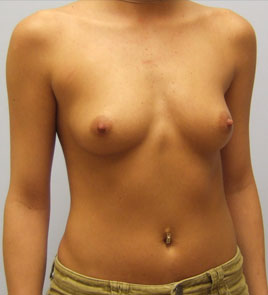 Breast Augmentation Before & After Image