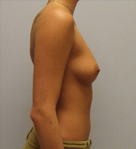 Breast Augmentation Before & After Image