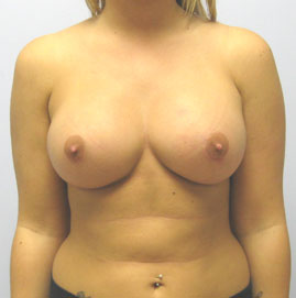 Breast Augmentation Before & After Image