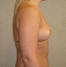 Breast Augmentation Before & After Image