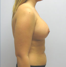 Breast Augmentation Before & After Image