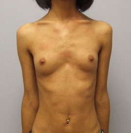 Breast Augmentation Before & After Image