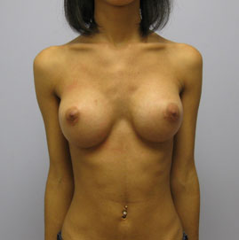 Breast Augmentation Before & After Image