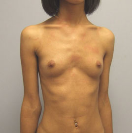 Breast Augmentation Before & After Image