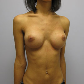 Breast Augmentation Before & After Image